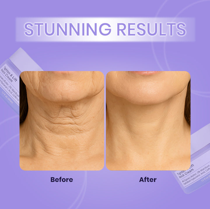 كريم شد ورفع الرقبة